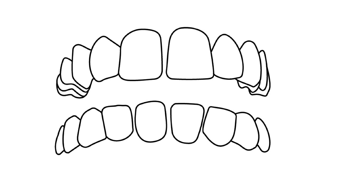 Crowded Spaced out teeth